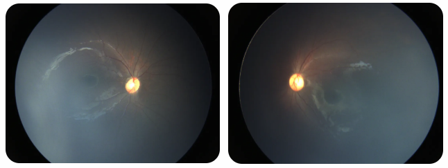 早產兒視網膜病變